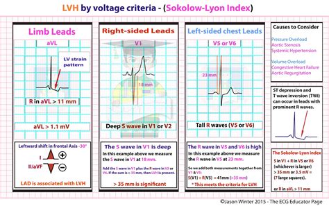 ecg voltage criteria for lvh.